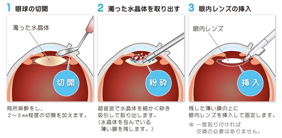 超音波水晶体乳化吸引術（PEA）