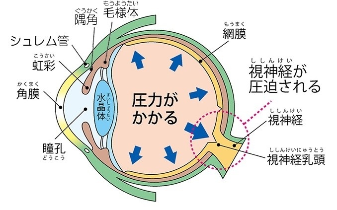 緑内障が起こる仕組み