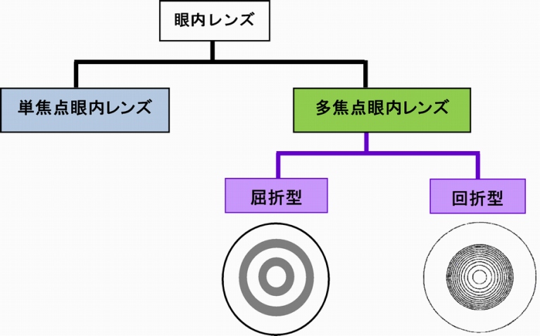 多焦点眼内レンズの種類