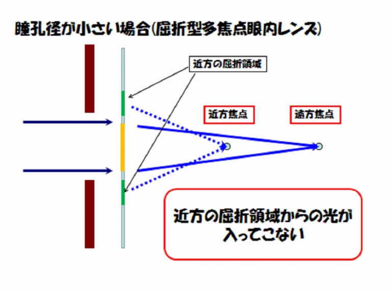 回折型