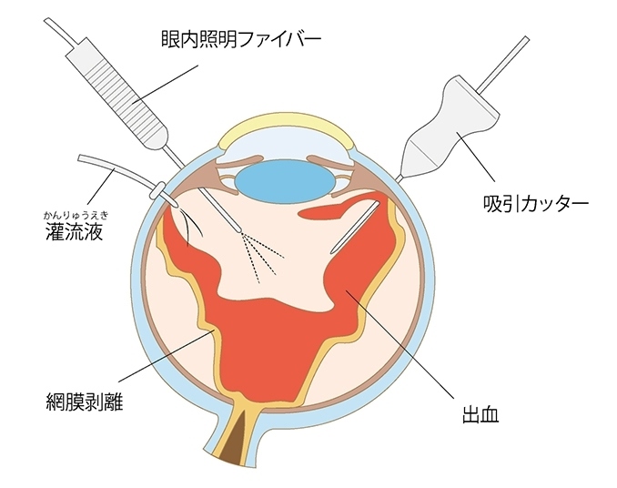 手術の方法